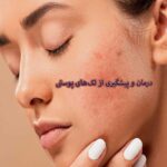 پیشگیری از لک پوستی