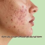 نوره برای جوش صورت