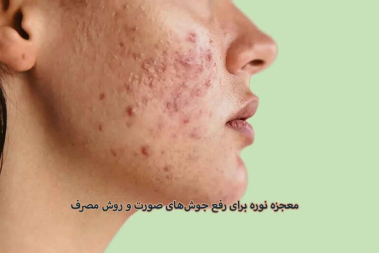 نوره ( واجبی ) برای جوش صورت ؛ معجزه نوره برای رفع جوشهای صورت و روش مصرف صحیح