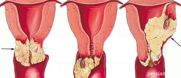 پیشگیری سرطان دهانه رحم پیشگیری سرطان دهانه رحم