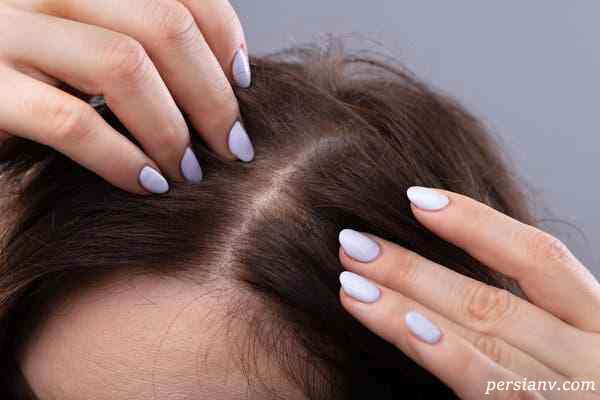 علت ریزش مو بعد از رژیم غذایی