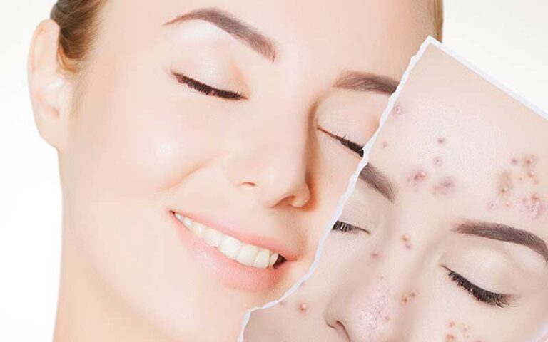 چگونه جوش صورت را درمان کنیم؟