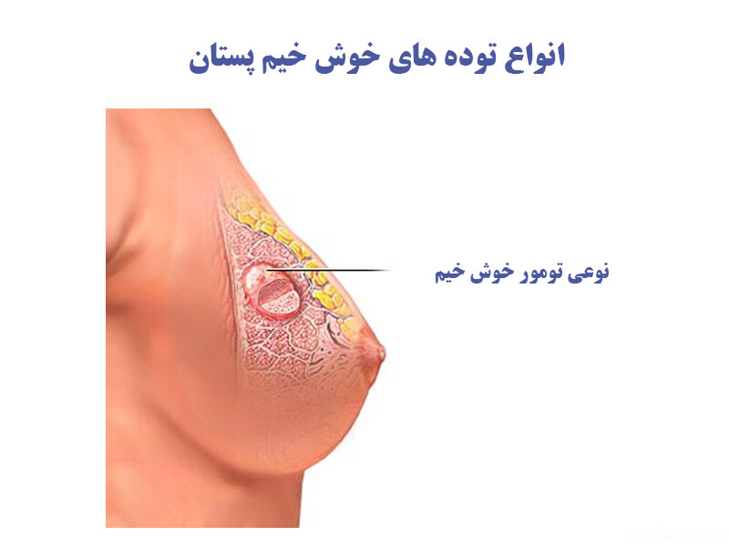توده های سرطانی توده های سرطانی