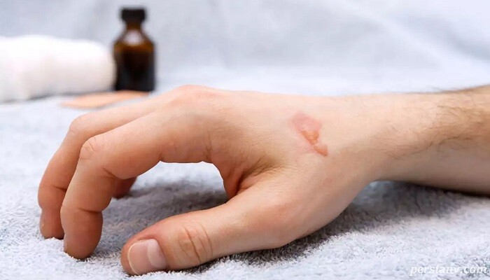 از بین بردن جای سوختگی پوست