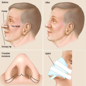 حکم شرعی عمل جراحی بینی را میدانید؟