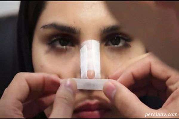 ورم بینی بعد از عمل