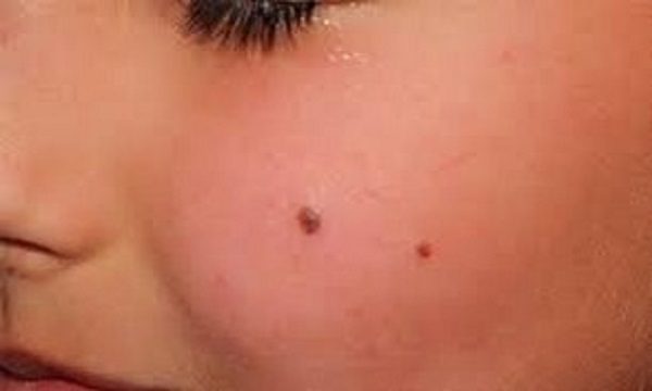 خالهای سیاه روی صورت