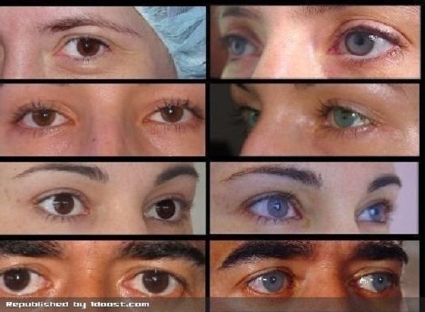 تغییر رنگ دائمی چشم