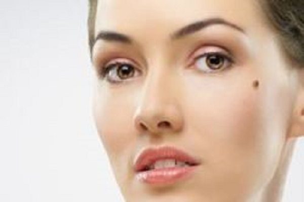 از بین بردن خال گوشتی